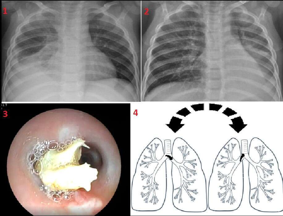 Fig. A1   Right lower lobe consolidation with mild-moderate amount of right side pleural effusion Fig. A2   Left lower lobe consolidation with atelectasis and mild amount of pleural effusion Fig. A3 A foreign body lodged at the entrance of left main bronchus at the level of the carina. Fig. A4 A demonstration of FB stuck in the Carina, tilting and obstructing alternately the entry of both right and left main Bronchus 